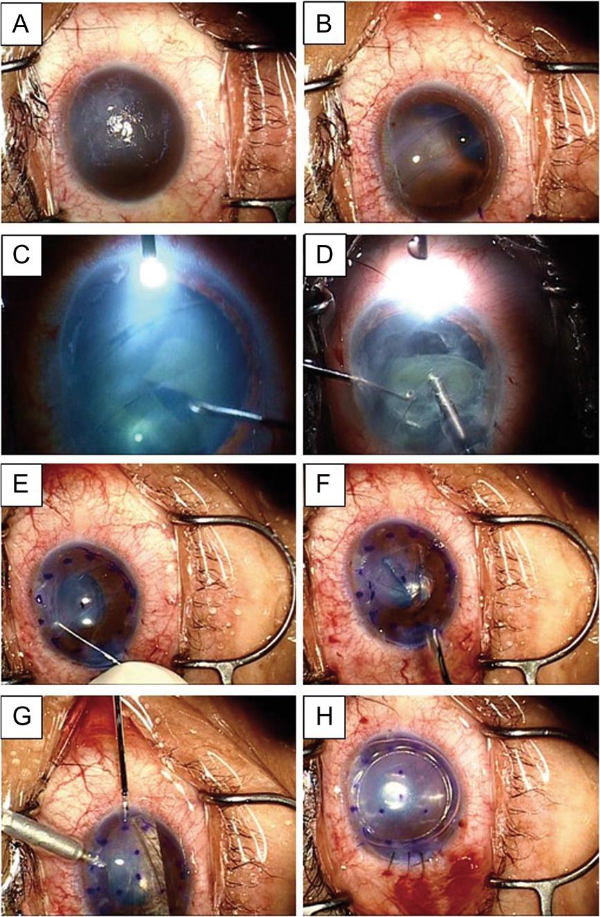 Kobayashi et al. BMC Ophthalmology (2015) 15:92 Page 5 of 7 Fig. 2 Representative surgical video images of case 3.