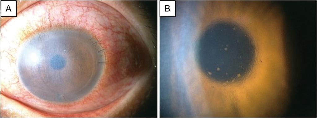 Kobayashi et al. BMC Ophthalmology (2015) 15:92 Page 6 of 7 Fig. 3 Representative anterior segment optical coherent tomographic images of case 1.