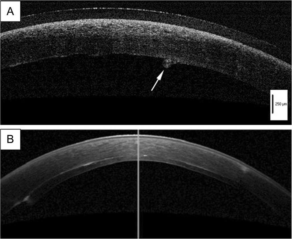 b Six months after DSEAK, the donor endothelial graft was completely attached behind the host cornea.