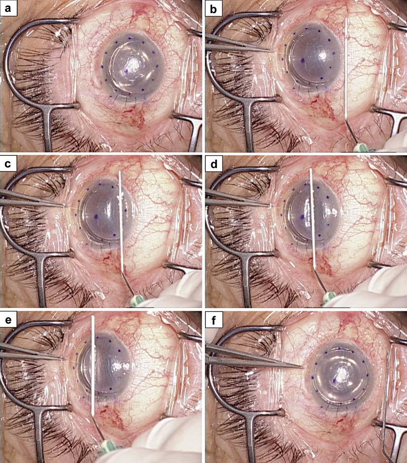 218 Fig. 2. No-touch technique with ocular tilt. a After air injection into the anterior chamber, donor dislocation is moderate. In such cases, simple corneal surface massage may not succeed.