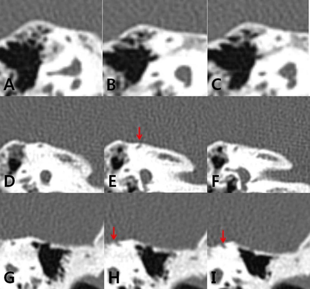 Fig. 1. Classification of the degrees of superior canal dehiscence (SCD) in three consecutive coronal computed tomography images. (A C) Normal: the bone overlying the superior canal is intact.