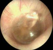 Spot the difference! Acute Otitis Media (AOM): The rapid onset of signs and symptoms such as otalgia and fever. (Bluestone 2007).
