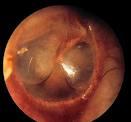 org Otitis media with effusion (OME): Inflammation of the middle ear with a collection of fluid in the middle ear space.