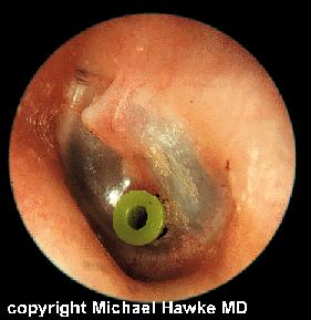 It works by varying the pressure within the ear canal and measuring the movement of the tympanic membrane.