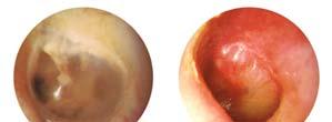 entry of foreign objects The Middle Ear The middle ear, or tympanic cavity, is separated
