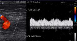 Spectral Doppler is not so easily used in establishing the flow course due to the need of permanently adapting the Doppler angle and due to the rapid change of the positivity or negativity of the