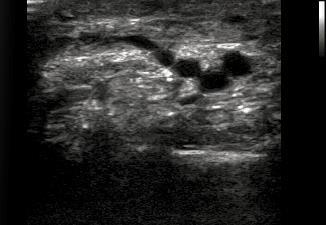 Local injection of peri-ulcer Ultrasound guidance critical in many cases veins