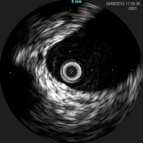 Use of IVUS to identify normal vs