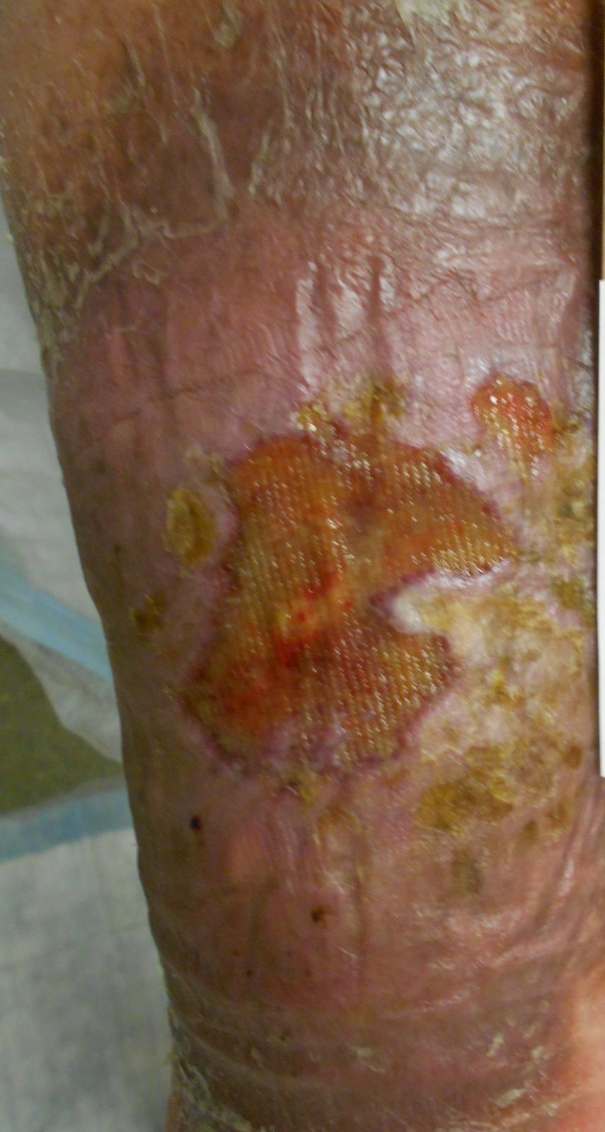 Chronic nonhealing leg ulcer 52 YO male w h/o multiple DVTs starting 11 yrs before initial visit in