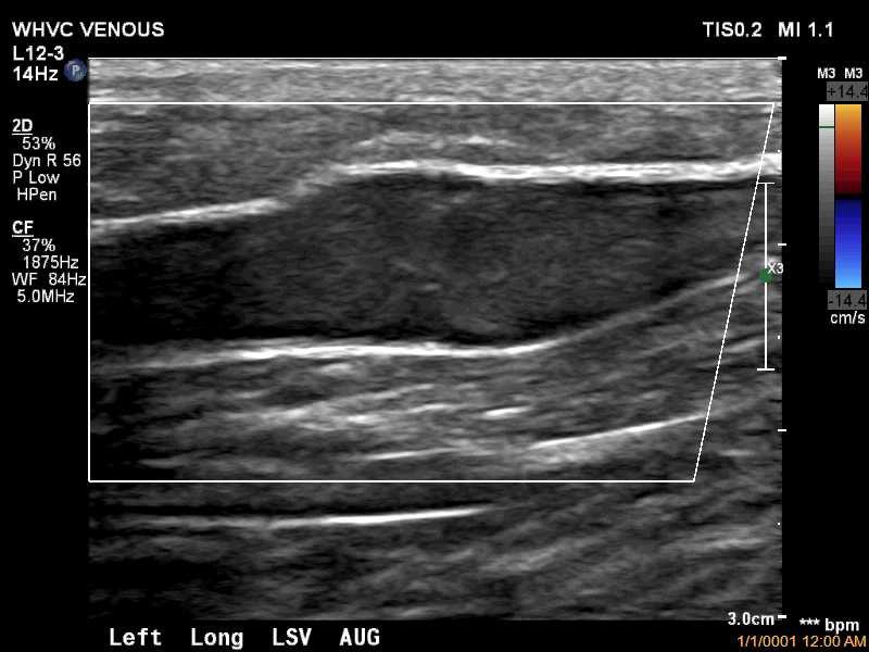 Ultrasound Guidance During Radiofrequency Ablation Survey of the gsv starting at the groin continuing to below