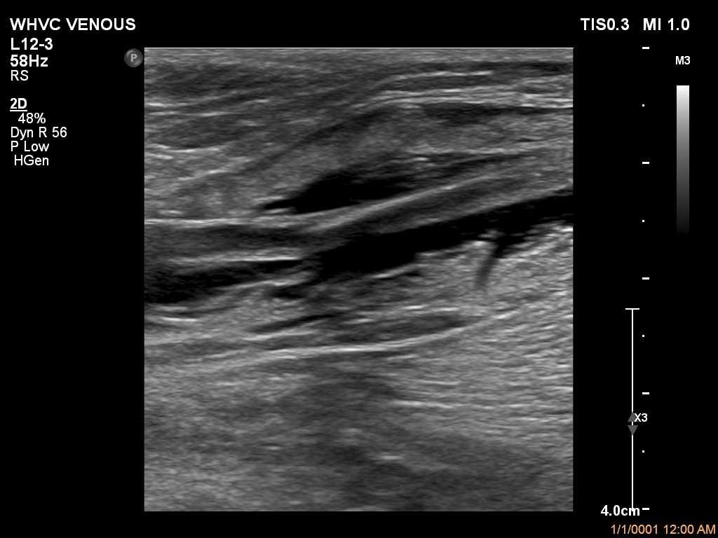 Post Ablation Ultrasound Insure closure of the treated vein and affected branches Insure absence of a endothermalheat