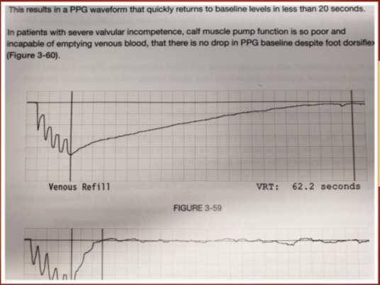 Photoplethysmography (PPG) Physiologic Testing: Techniques and Interpretation 2 nd ed 2012 Robert Scisson, RVT pp76-77 A normal response to calf muscle activity is a reduction of venous volume and