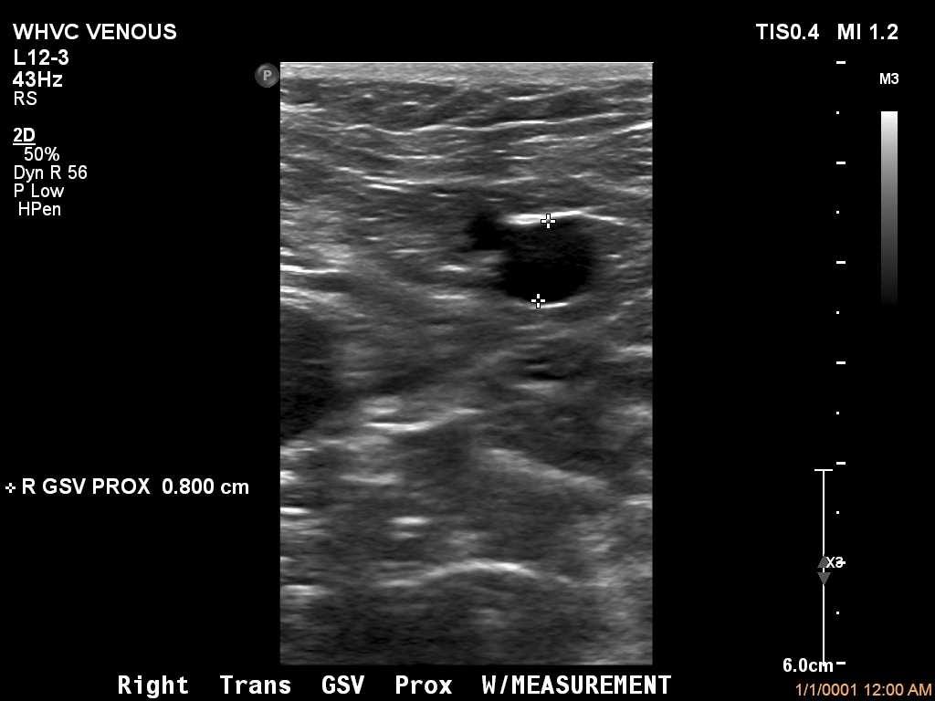 Take measurements at the SFJ and Prox GSV to identify enlargement of the vessels Normal GSV should be under 4mm Doppler Evaluation Performed