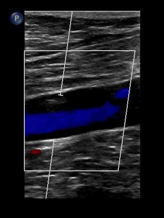 The veins of the distal leg are accessed with an augment due to valsalvabecoming less effective as you move further down the leg Sample