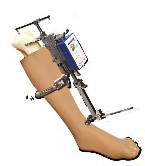 d Secure the mid-tibia v-rest of the tibial jig with the calf spring and adjust malleolar probe so b that v-rest sits firmly on anterior tibia.