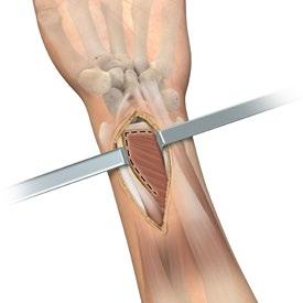 more proximal than the Standard plates 1 Exposure Supinate the patient s forearm to expose the surgical site. To maximize exposure, place a towel under the wrist, supporting it in extension.