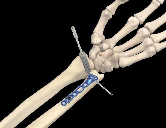 Acu-Loc Volar Distal Ulna (VDU) Plate Surgical Technique [continued] 3 Nonlocking Proximal Screw Placement Place the first 3.