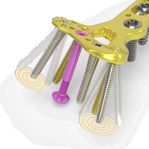 These screws are provided to aid in the capture of specific fragments or to accommodate variations in