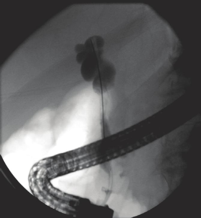 4 Gastroenterology Research and Practice Liver Dilated proximal extrahepatic duct Liver Tip of deployment catheter Air in intrahepatic ducts Strictured midextrahepatic duct Partially deployed