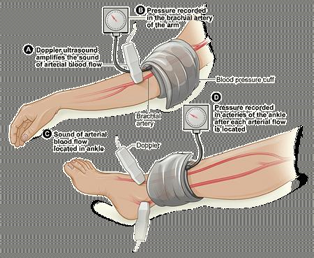 Noninvasive Screening: Ankle-Brachial Index (ABI) Ratio of ankle to arm systolic blood pressure (SBP) ABI 0.