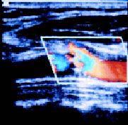 Noninvasive Screening: Carotid Intima-Media Thickness (CIMT) CIMT measured by carotid artery ultrasound 1 SHAPE Task Force: Warranted for screening asymptomatic men 45 to 75 years old and women 55 to