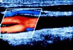 2 Significant internal carotid stenosis in the region of an echogenic plaque indicated by color flow Doppler aliasing, with lighter shades of color indicating turbulence with increased velocity of