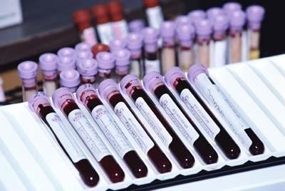 Blood Test FBS Lipid panel