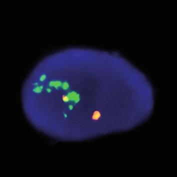 Cell with high level amplification of ERBB2 Green signals overlapping orange signals.