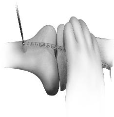 PROXIMAL ATTACHMENT OF THE JOINT RULER After a standard anteromedial exposure, use the Bone Screw Drill to drill a hole through the anterior femoral cortex