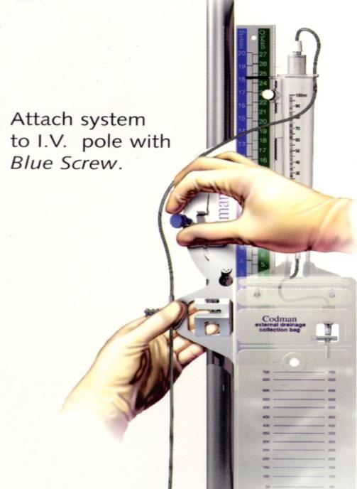 Figure 1 1) Secure the Codman system to the IV pole by