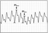 Applies to lots of measures Systolic pressure variation Pulse pressure variation Plethysmogram variation