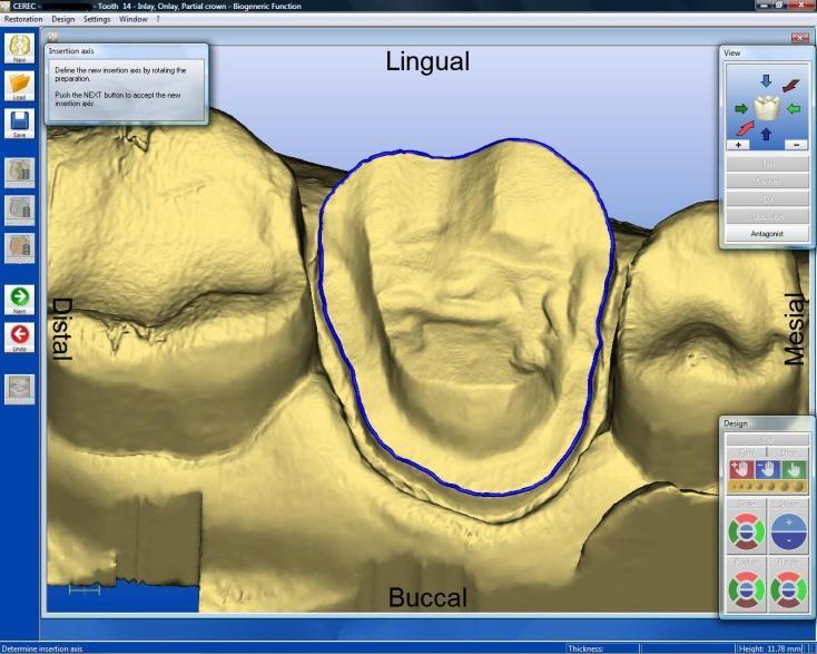 This preparation provides very significant conservation of the lingual cusp and buccal and proximal walls providing resistance to rotation and accurate seating.