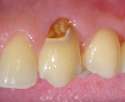 Technique Indirect and direct pulp capping same as deep cavity depth Carious lesion Deep preparation, vital tooth, YOU