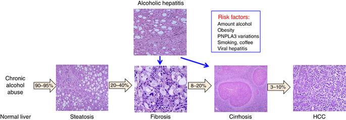 Disease spectrum of alcoholic liver disease Figure 1: Disease