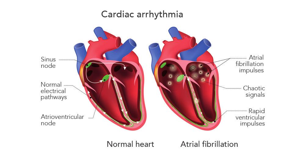 ARRHYTHMIA ABLATION OVERVIEW OF ARRHYTHMIA WHAT IS AN ARRHYTHMIA? There are some people who experience abnormal heart rhythms. The heart rate may be too fast or frequently irregular.