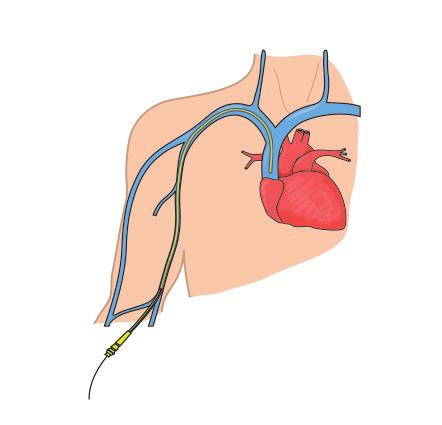 WHICH TYPES OF ARRHYTHMIA CAN BE TREATED WITH ABLATION?