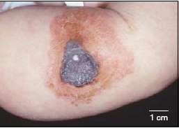 Cutaneous Anthrax: Clinical Progression Local Edema Ulcer forms (Day 2) Small vesicles appear discharging clear or