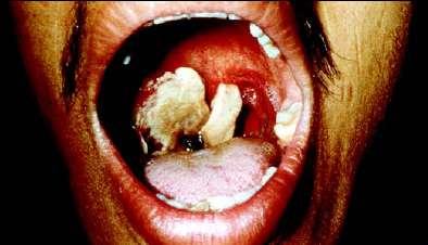 GI Anthrax: Clinical Progression UPPER GI Oral or Esophageal Ulcer Regional Lymphadenopathy