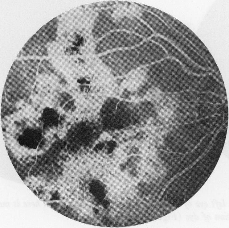 Placoid pigment epitheliopathy Fluorescein angiography showed extensive areas of atrophic pigment epithelium, much more than could be predicted from ophthalmoscopic examination alone (Fig. 4).