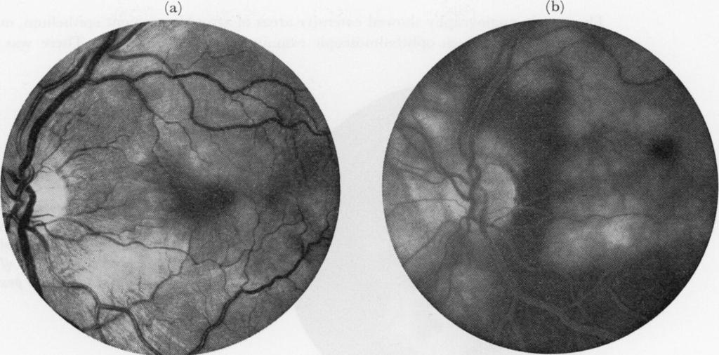 868 A. F. Deutman, J. A. Oosterhuis, T. N. Boen- Tan, and A. L. Aan de Kerk (st} ~~~~~~~~~~~~~~(b) FIG 5a, b Fluorescence photographs of the left eye of Case 2 on April 10o, 1970.