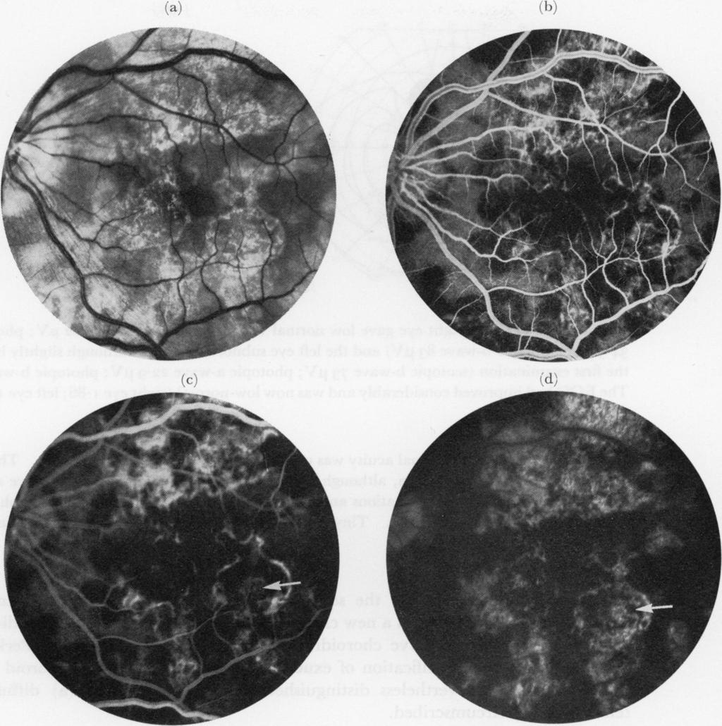 Placoid pigment epitheliopathy FIG. 8a,b,c,d Fluorescence angiography of left eye of Case 3, showing defective pigment epithelium and pigment scarring. There is no oedema centrally.