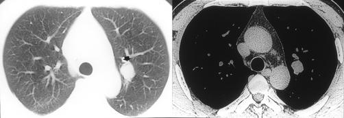 C D E F Fig. 2. Typical carcinoid in a aymptomatic 52-year-old man,, C.