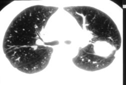obstruction including atelectasis, recurrent pneumonia, and obstructive pneumonitis are common radiographic findings (Fig. 1) (5).