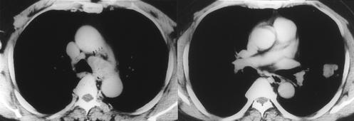 Mediastinal lymphadenopathy was noted in three (Fig. 5) and in one case there was distant metastasis to the liver.
