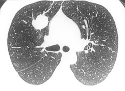 Fig. 7. Small cell carcinoma in a asymptomatic 44-year-old man.. CT scan in lung window setting shows a well-defined, lobulated, 2.