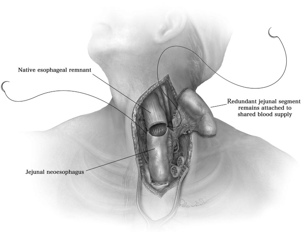 Supercharged jejunal flap for esophageal reconstruction 253 Figure 10 The jejunum is divided at an appropriate level to anastomose with the esophagus. This can be a hand-sewn or stapled anastomosis.