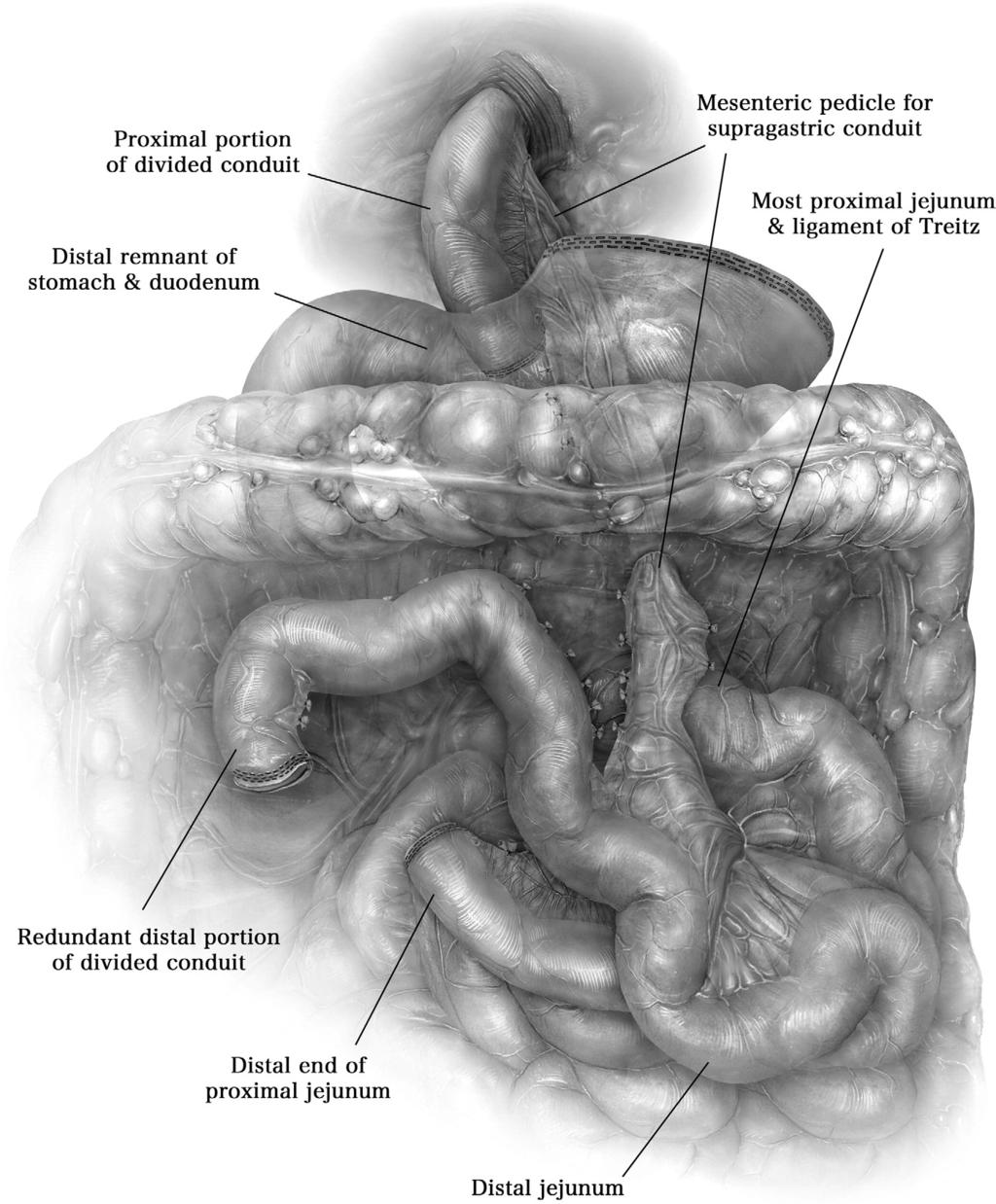 254 D.C. Rice and P. Yu Figure 11 The conduit is usually passed into the chest through the mesocolon and behind the stomach.
