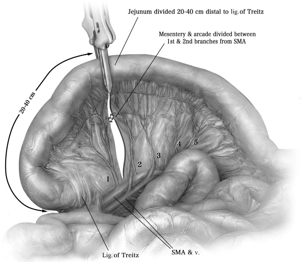 Supercharged jejunal flap for esophageal reconstruction 245 Figure 2 The proximal jejunum and mesentery are divided just distal to the last arborization of the first jejunal mesenteric branch,