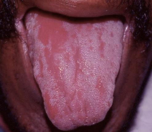 Oral Candidiasis: Erythematous