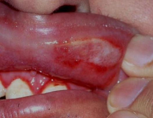 Question 4 This 32-year-old man has severe extremely painful aphthous stomatitis that has not